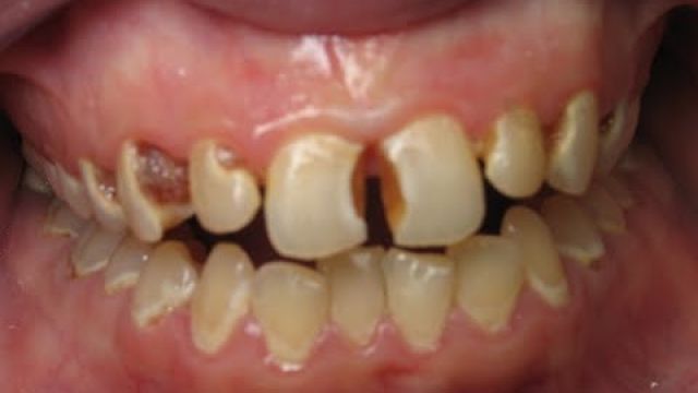 Effects of Sugar on Health - The Leading Cause Of Health Diseases?